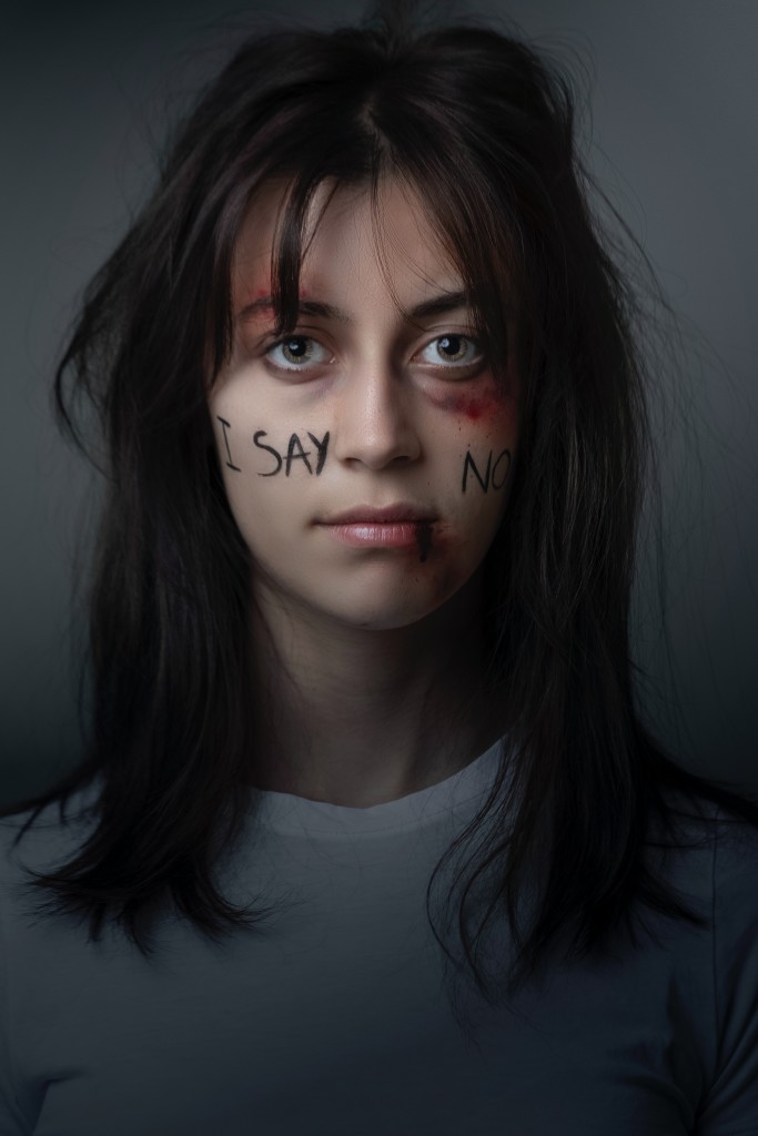 Nell'immagine una giovane donna con i segni della violenza - Smart Marketing